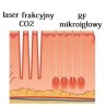 FraxRF - Mezoterapia mikroigłowa frakcyjna połączona z RF